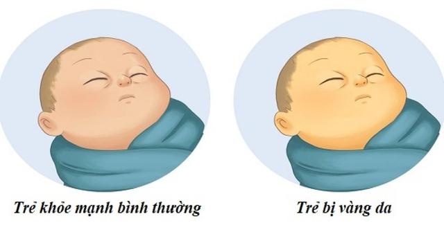 Vàng da ở trẻ sơ sinh: Cách phát hiện, phân biệt với các bệnh lý và phương pháp điều trị - Ảnh 2.