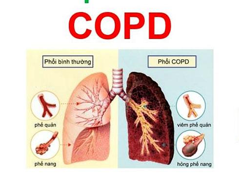 Những lưu ý về bệnh COPD - Báo Khánh Hòa điện tử