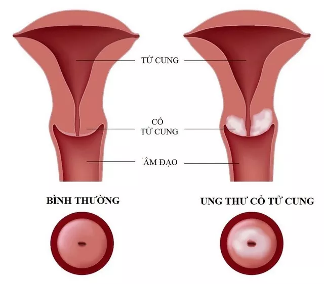 Cổ tử cung đóng vai trò rất lớn trong quá trình sinh sản và sinh lý bình thường của phụ nữ.